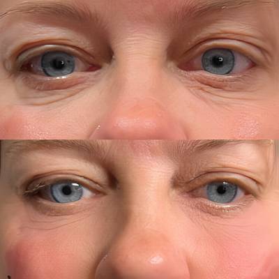 BOTOX