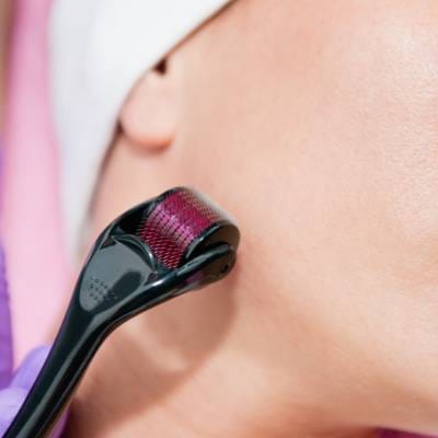 MICRONEEDLING